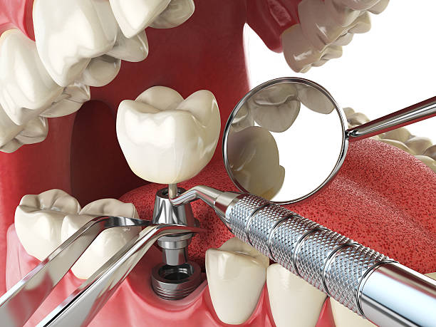 Best Emergency Dental Care for Broken or Chipped Teeth in Cortland, IL